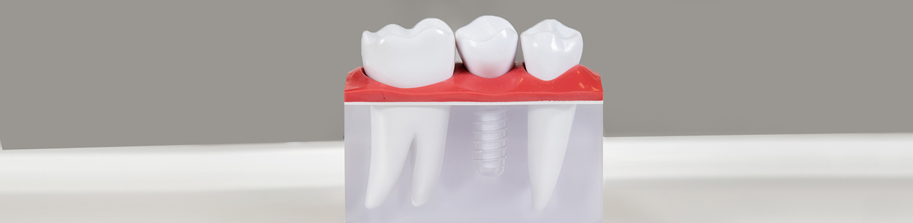 Comparing Clear Aligners and Traditional Braces in Knoxville, TN