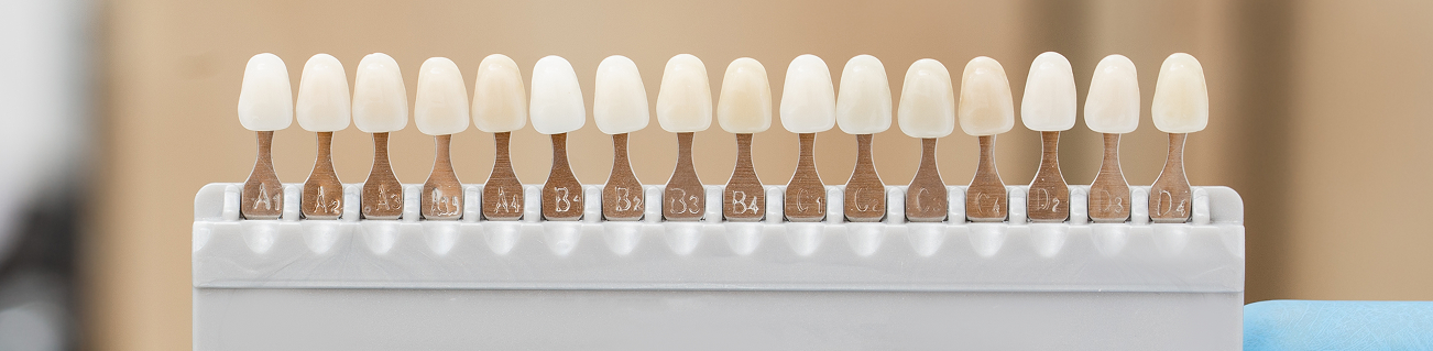 What Every Knoxville Patient Should Know About Veneer Longevity