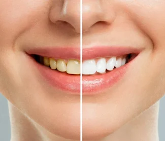 Teeth Whitening in Knoxville, TN. Whitening dentist near you